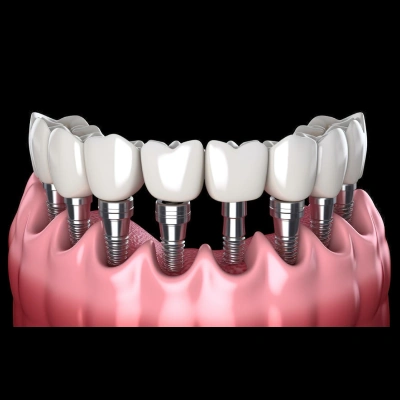 Full mouth rehabilitation with All-on-4 dental implants